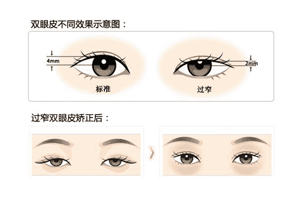 割双眼皮后多久可以恢复快速恢复的方法有哪些