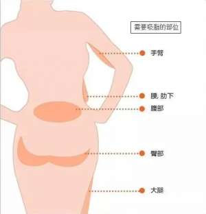 双下巴吸脂的操作方式及护理