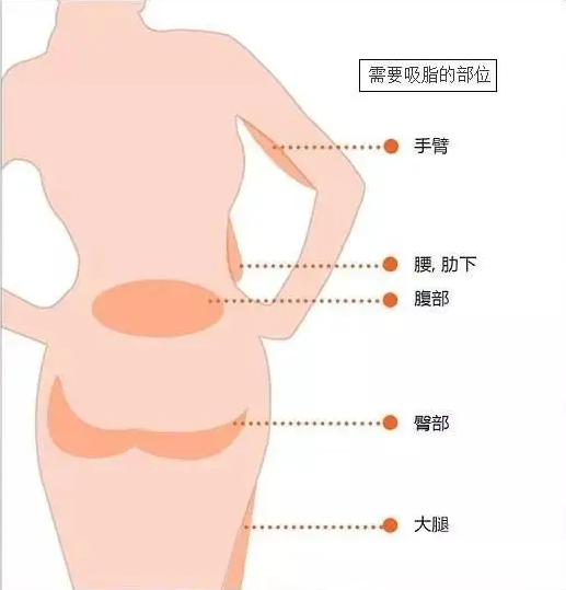 面部吸脂可以一次塑形吗保定华美整形为你解答