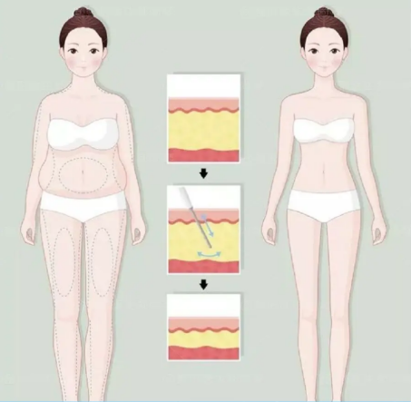 谁可以做流体动力吸脂呢安徽省立医院整形告诉你